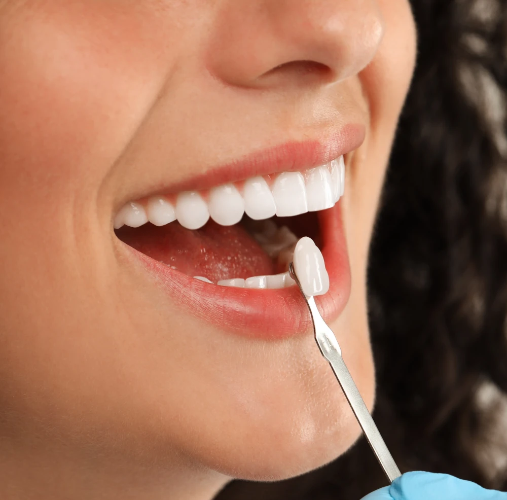 Dentist applying porcelain veneer to smiling patient
