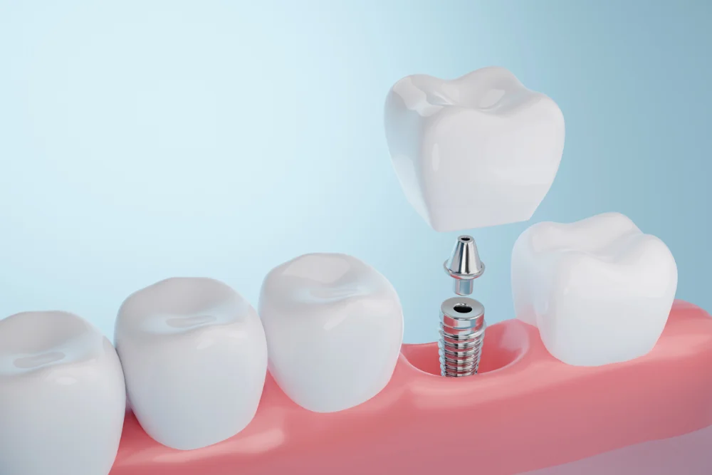 3D illustration of a single dental implant procedure explained visually