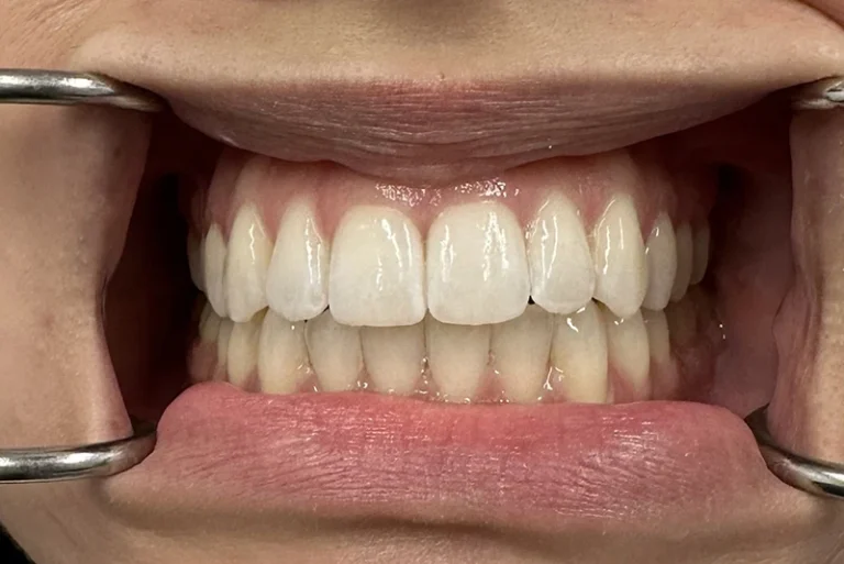 cosmetic-dentistry-after-case3-robina-quays-dental-care-robina