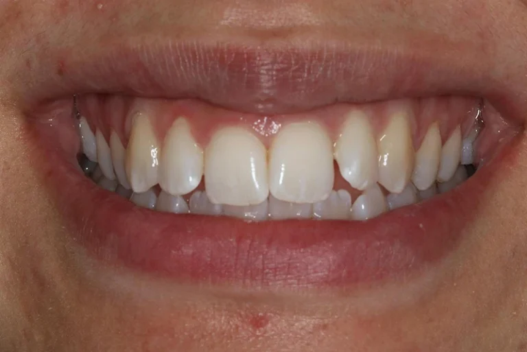 cosmetic-dentistry-before-case3-robina-quays-dental-care-robina