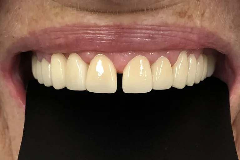 cosmetic-smile-reconstruction-after-case12-robina-quays-dental-care-robina