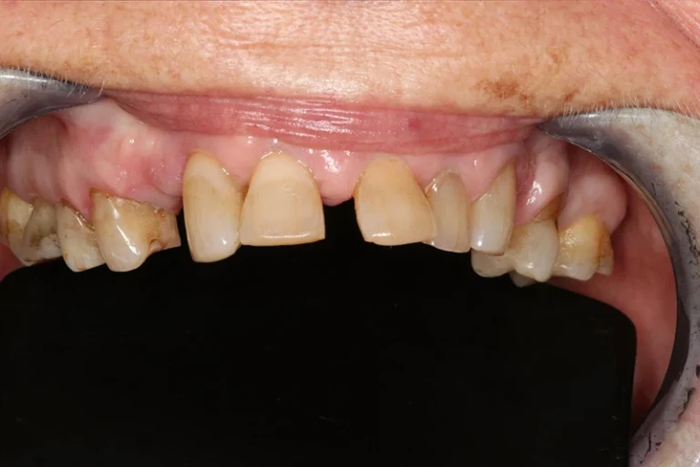 cosmetic-smile-reconstruction-before-case12-robina-quays-dental-care-robina