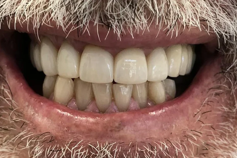 dental-bridge-after-case10-robina-quays-dental-care-robina