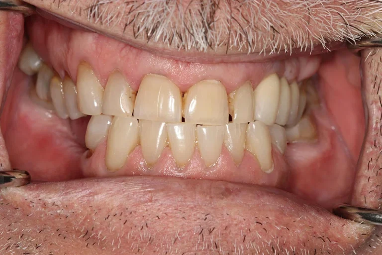 dental-bridge-before-case10-robina-quays-dental-care-robina