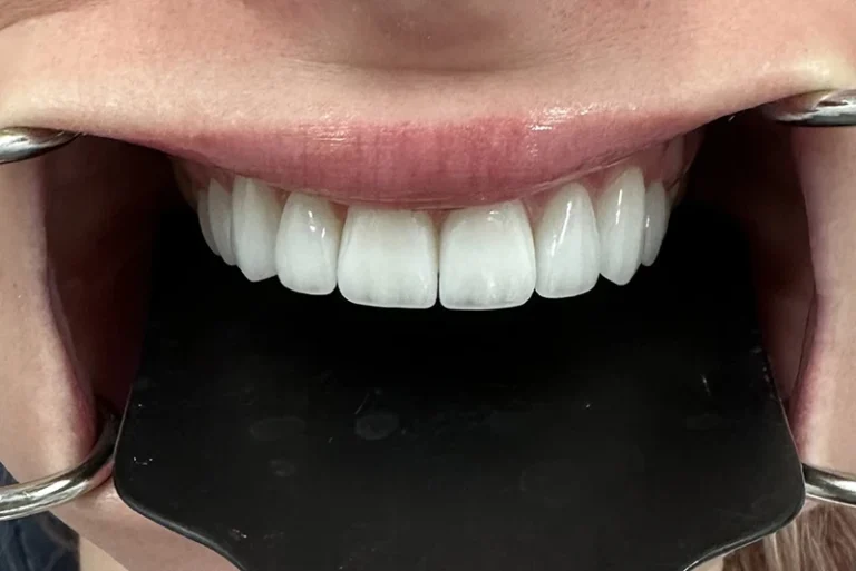 dental-crown-restoration-after-case5-robina-quays-dental-care-gold-coast