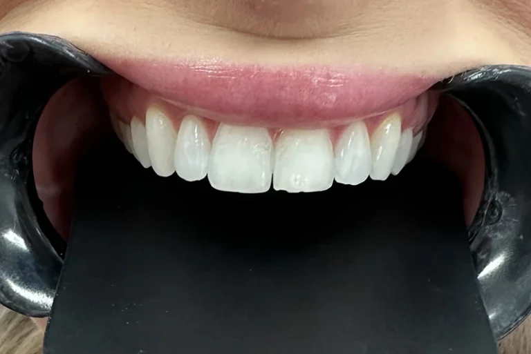 dental-crown-restoration-before-case5-robina-quays-dental-care-gold-coast