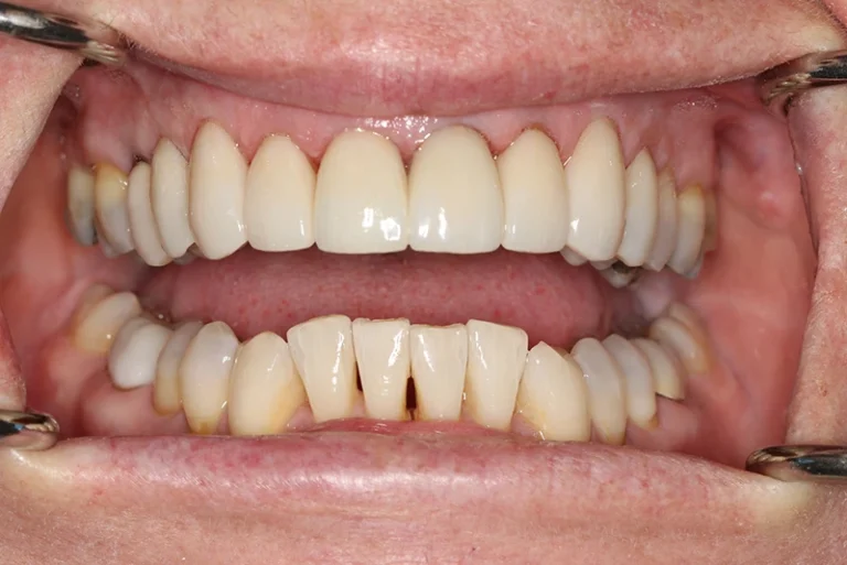 dental-implants-after-case7-robina-quays-dental-care-robina