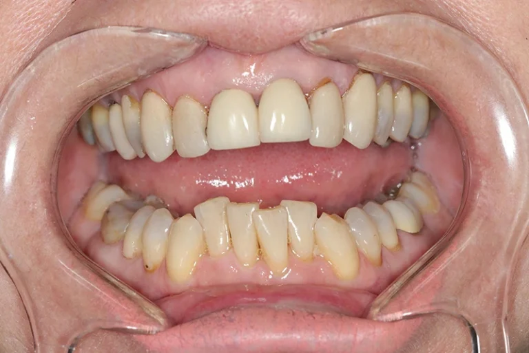 dental-implants-before-case7-robina-quays-dental-care-robina