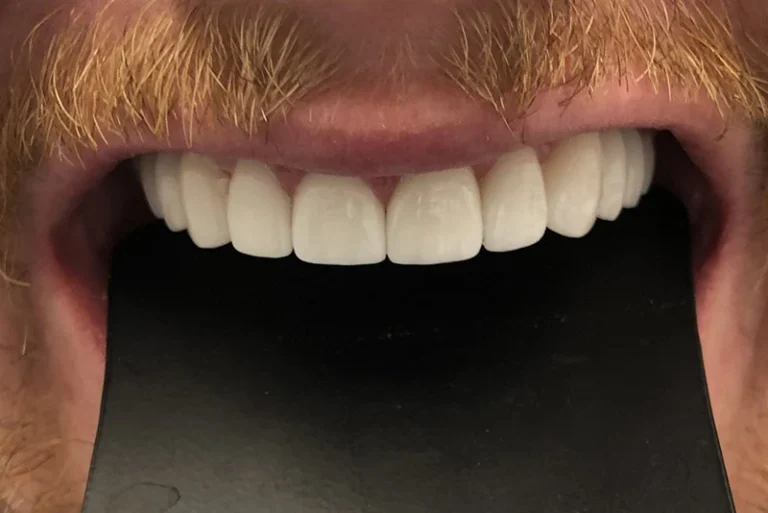 dental-restoration-after-case11-robina-quays-dental-care-gold-coast