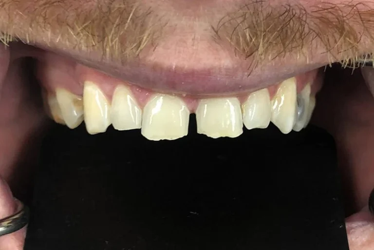 dental-restoration-before-case11-robina-quays-dental-care-gold-coast