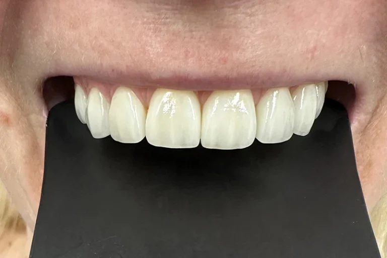 dental-veneers-after-case2-robina-quays-dental-care-gold-coast