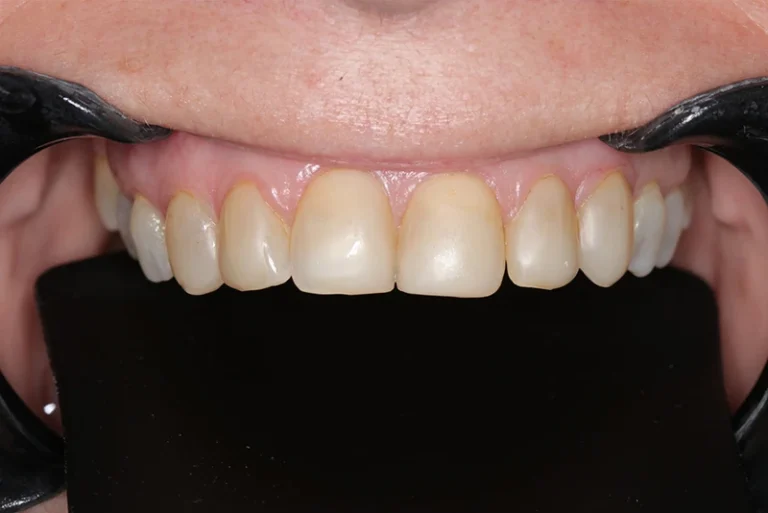dental-veneers-before-case2-robina-quays-dental-care-gold-coast