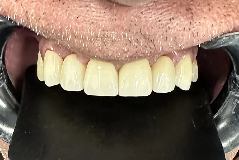 full-mouth-rehabilitation-after-case6-robina-quays-dental-care-gold-coast