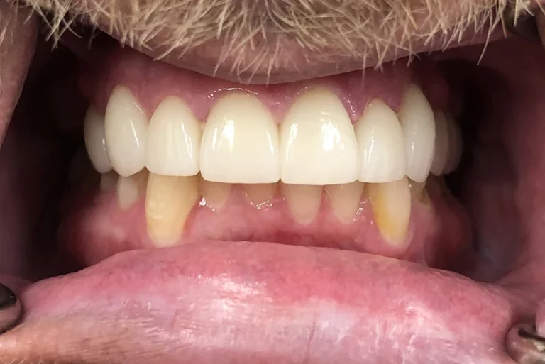 full-smile-transformation-after-case13-robina-quays-dental-care-qld