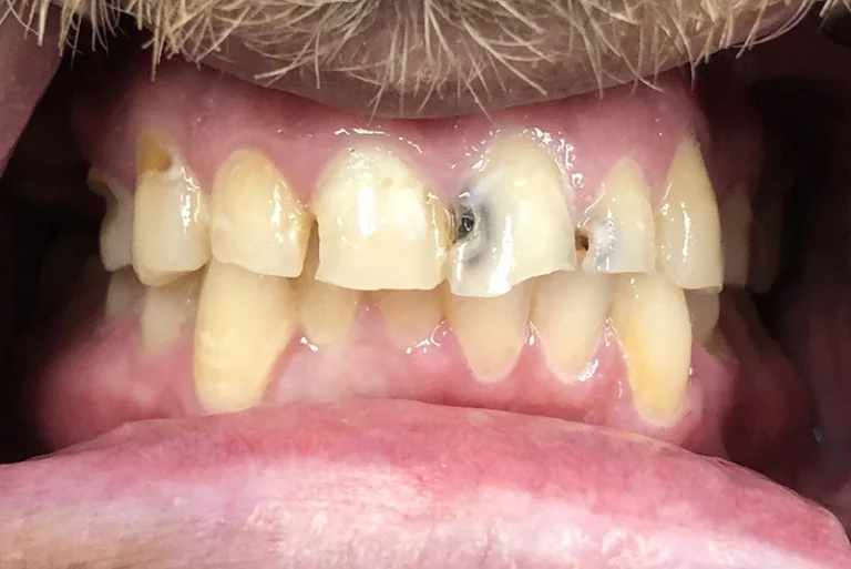 full-smile-transformation-before-case13-robina-quays-dental-care-qld