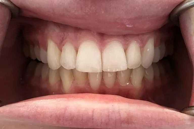 porcelain-veneers-after-case9-robina-quays-dental-care-gold-coast