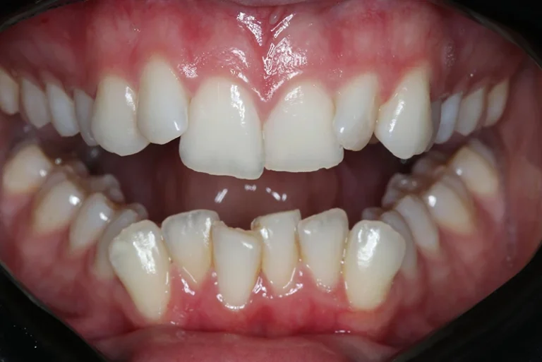 porcelain-veneers-before-case9-robina-quays-dental-care-gold-coast