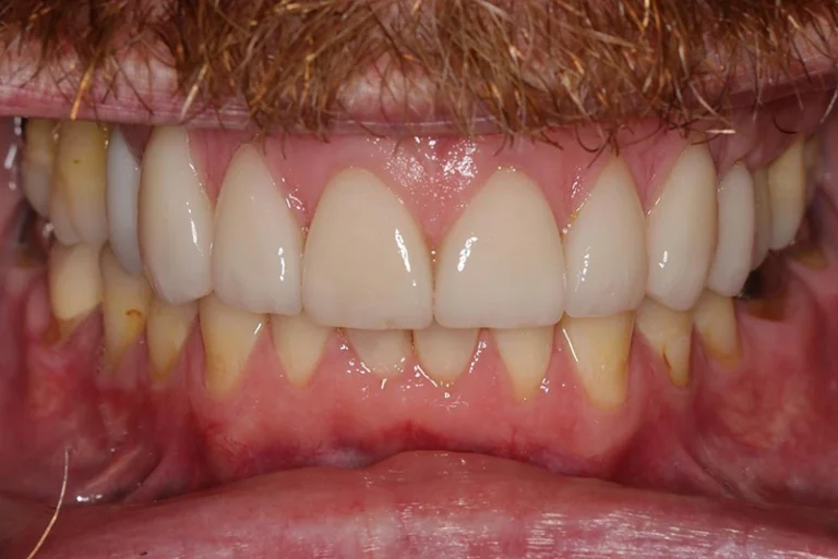 smile-design-after-case8-robina-quays-dental-care-qld