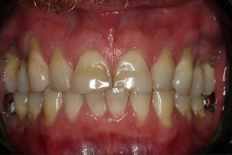 smile-design-before-case8-robina-quays-dental-care-qld
