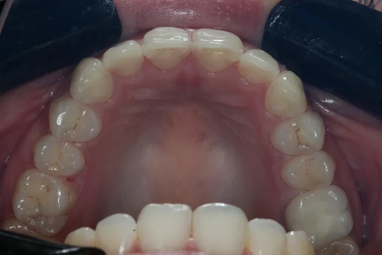 smile-makeover-after-case4-robina-quays-dental-care-qld