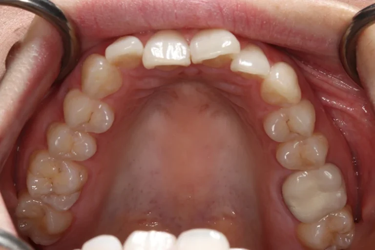 smile-makeover-before-case4-robina-quays-dental-care-qld