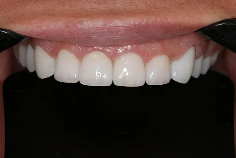 teeth-whitening-after-case1-robina-quays-dental-care-gold-coast