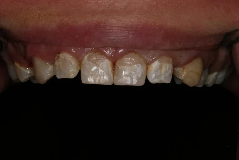 teeth-whitening-before-case1-robina-quays-dental-care-gold-coast